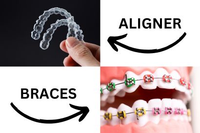 BRACES & ALIGNERS TREATMENT