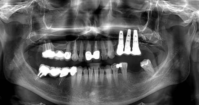 How Dental Implants Help Restore Jawbone Structure