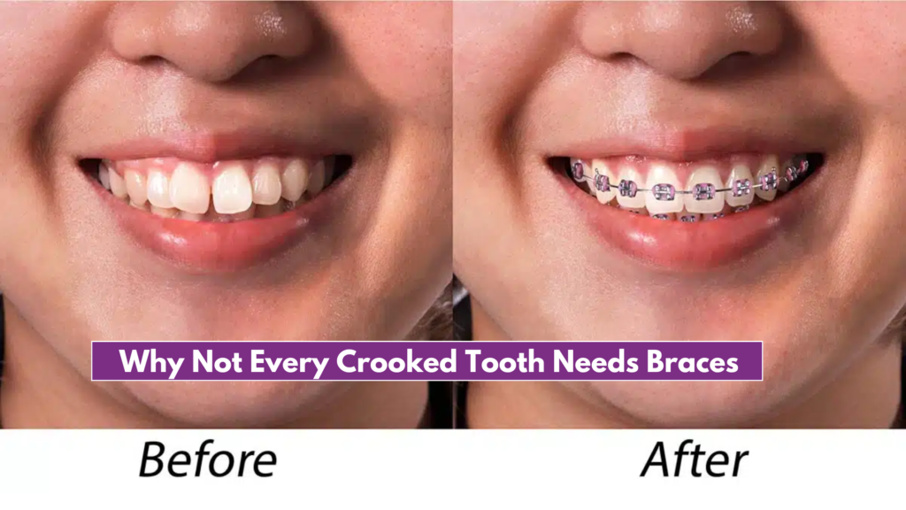 Why Not Every Crooked Tooth Needs Braces